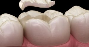Tooth Crown Procedure